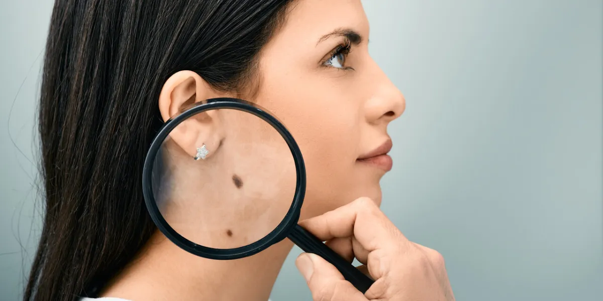 woman with magnifying glass showing mole and birthmark on her body for prevention of melanoma and nevus exam mole dermoscopy woman with magnifying glass showing mole and birthmark on her body for prevention of melanoma and nevus exam mole dermoscopy