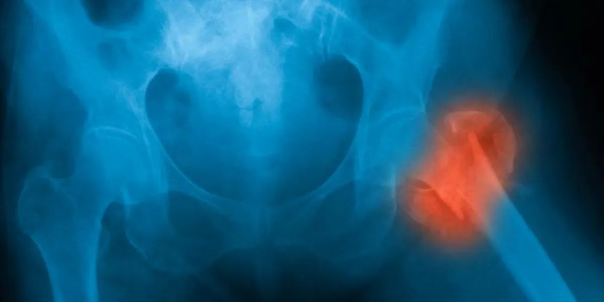 image radiographique de la hanche montrant une fracture du fémur du côté gauche image radiographique de la hanche montrant une fracture du fémur du côté gauche