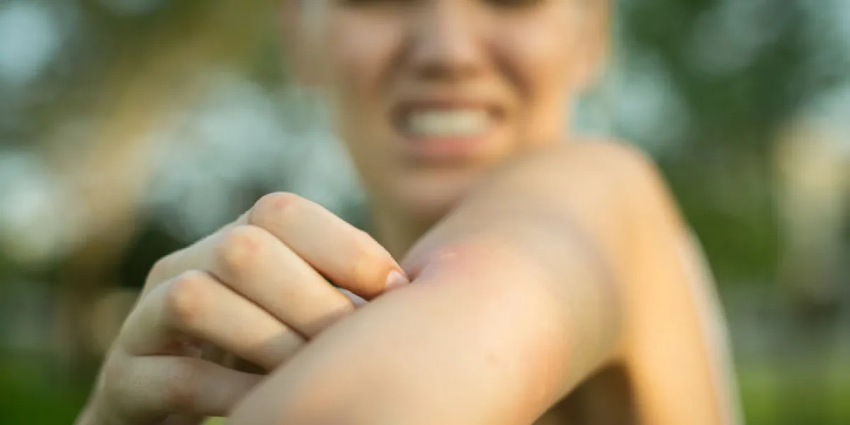 close up of a red mosquito bite on a person's arm, rubbing and scratching it outdoor in the park close up of a red mosquito bite on a person's arm, rubbing and scratching it outdoor in the park