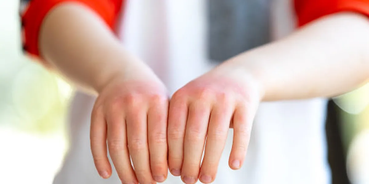 a little redhead boy is showing the sunburn he has on his hands his hands are very red and dry a little redhead boy is showing the sunburn he has on his hands his hands are very red and dry