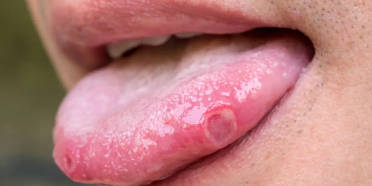tongue with ulcers of adult man tongue with ulcers of adult man