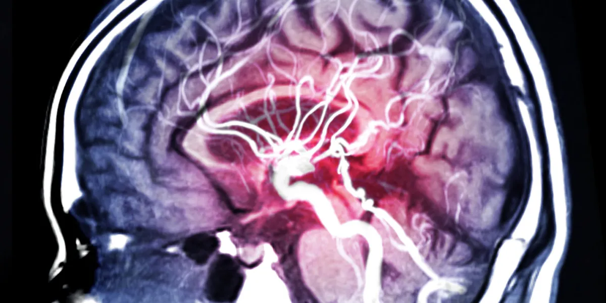 mra brain or magnetic resonance angiography (mri) of vessel in the brain sagittal view for evaluate them stenosis (abnormal narrowing), occlusions, aneurysms (vessel wall dilatations, at risk of rupture) or other abnormalities