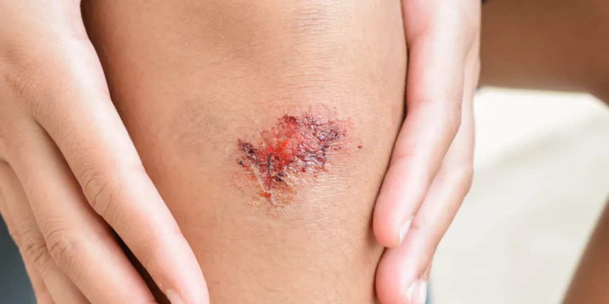 wound from knee fall wound from knee fall