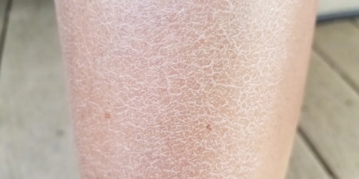 close up of a woman's dry flaky itchy legs close up of a woman's dry flaky itchy legs