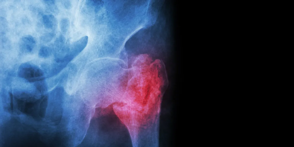intertrochanteric ( neck of femur ) fracture left femur ( thigh bone ) and blank area at right side