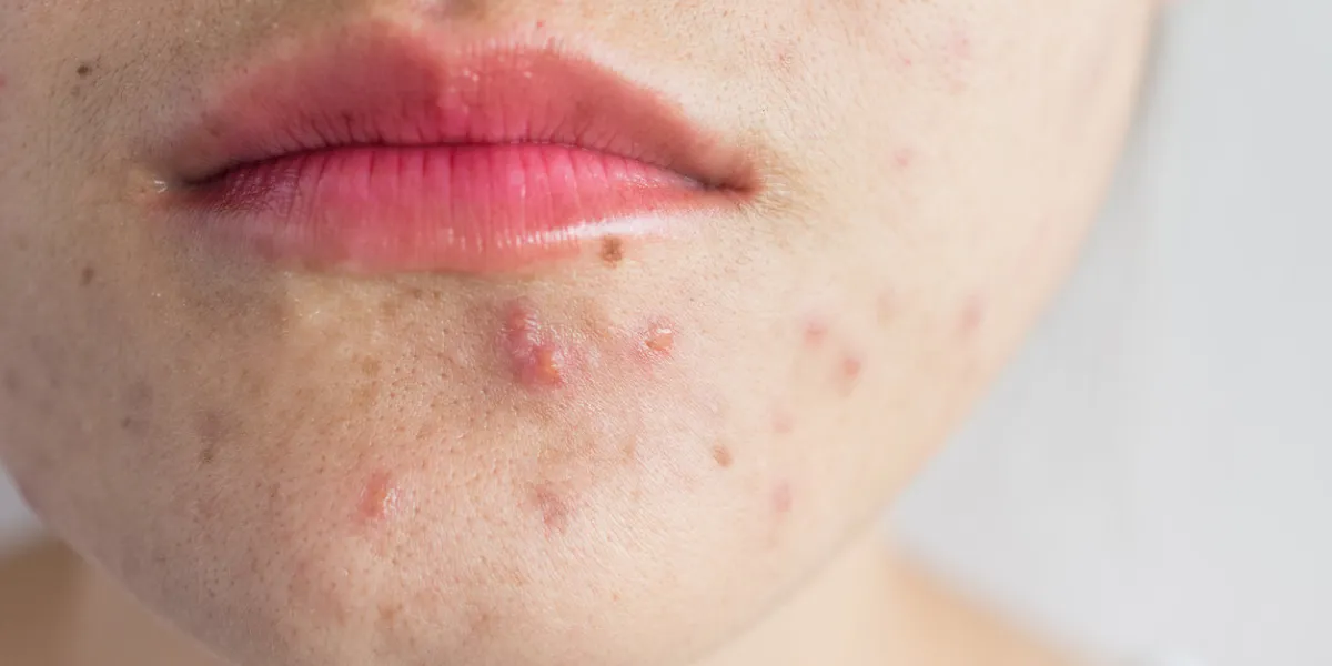 close-up of woman half face with problems of acne inflammation (papule and pustule) on her face close-up of woman half face with problems of acne inflammation (papule and pustule) on her face
