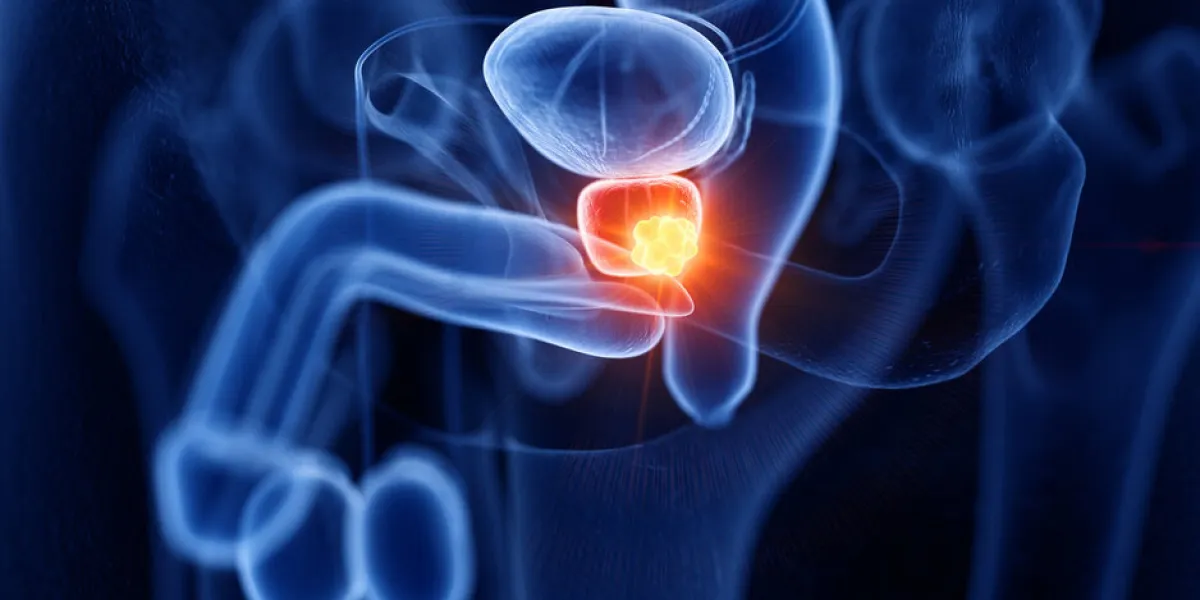3d rendered medically accurate illustration of prostate cancer 3d rendered medically accurate illustration of prostate cancer