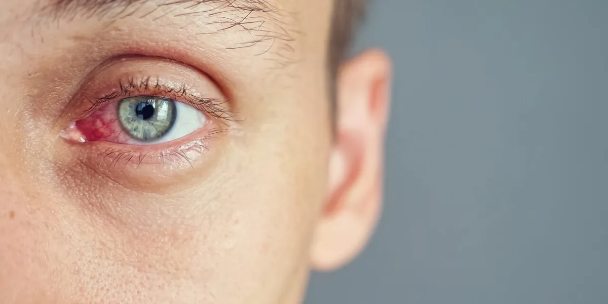 close up of the red eye of a man affected by an infection, copy space