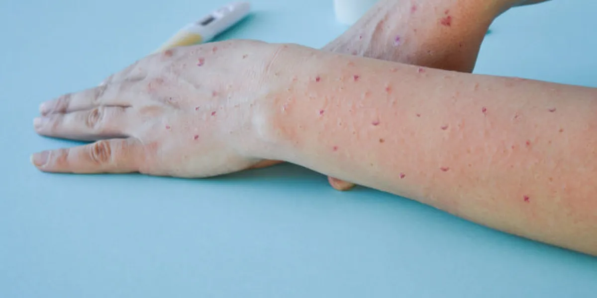 monkey pox virus, a new world problem of modern humanity close-up of the hands of a sick person with pimples and blisters smallpox vaccine monkey pox virus, a new world problem of modern humanity close-up of the hands of a sick person with pimples and blisters smallpox vaccine