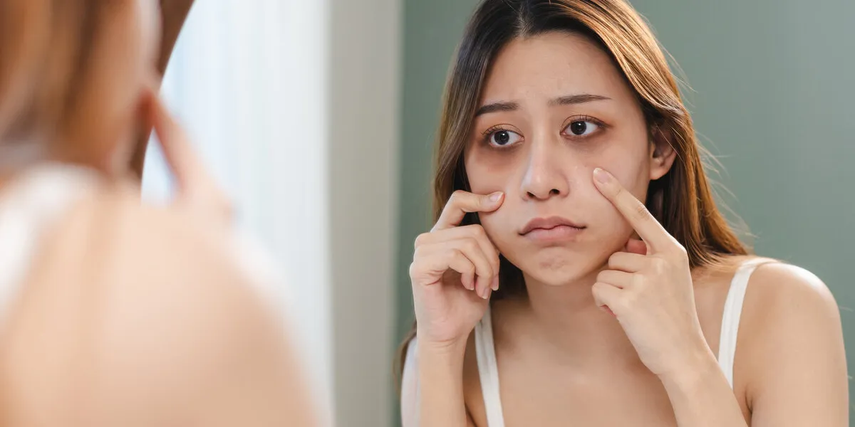 lack of sleep problem, worried asian young woman pointing finger at dark circles under her eyes lack of sleep problem, worried asian young woman pointing finger at dark circles under her eyes