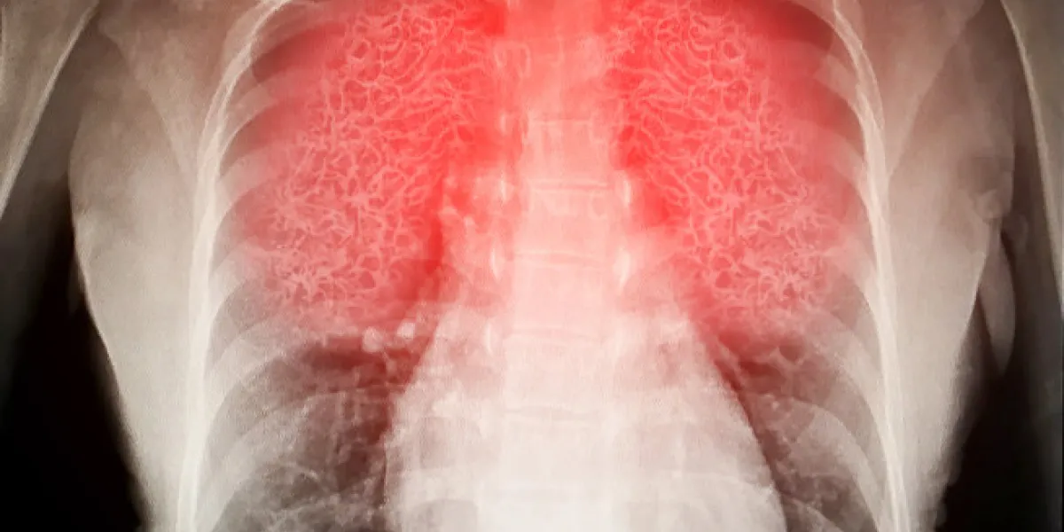 virus destroys human lungs the lnflamed a radiograph virus destroys human lungs the lnflamed a radiograph