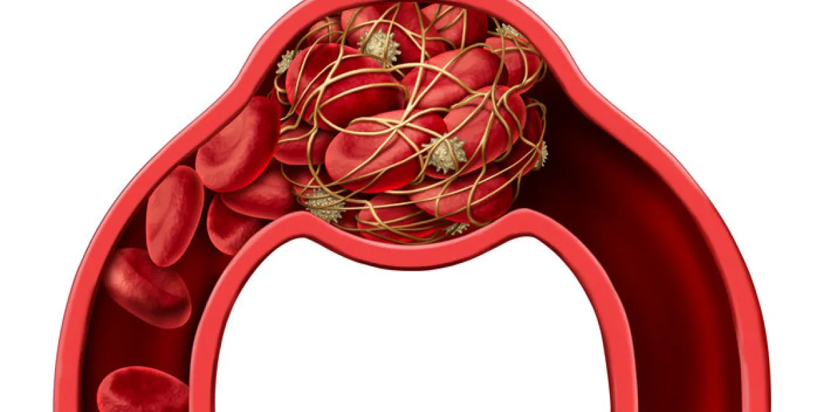blood clot disease symbol and thrombosis medical 3d illustration concept as a group of human blood cells clumped together by sticky platelets and fibrin creating a blockage in an artery or vein as a health disorder blood clot disease symbol and thrombosis medical 3d illustration concept as a group of human blood cells clumped together by sticky platelets and fibrin creating a blockage in an artery or vein as a health disorder