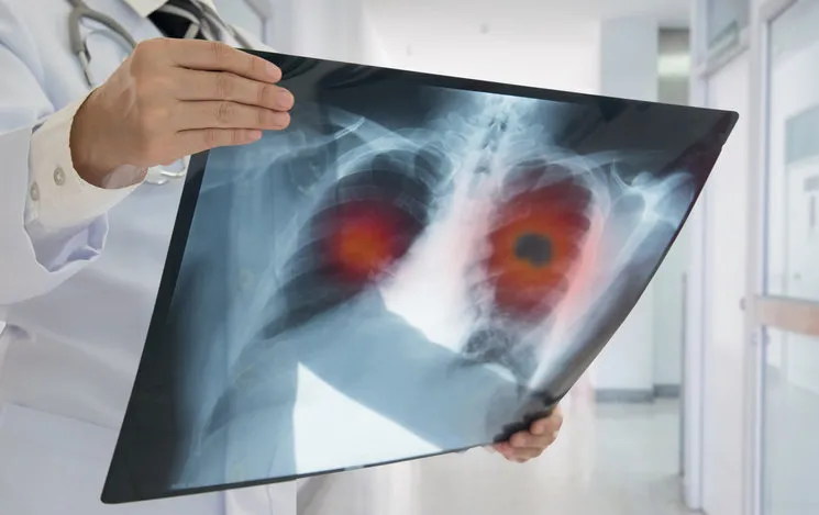 lung cancer doctor check up x-ray image have problem lung tumor of patient