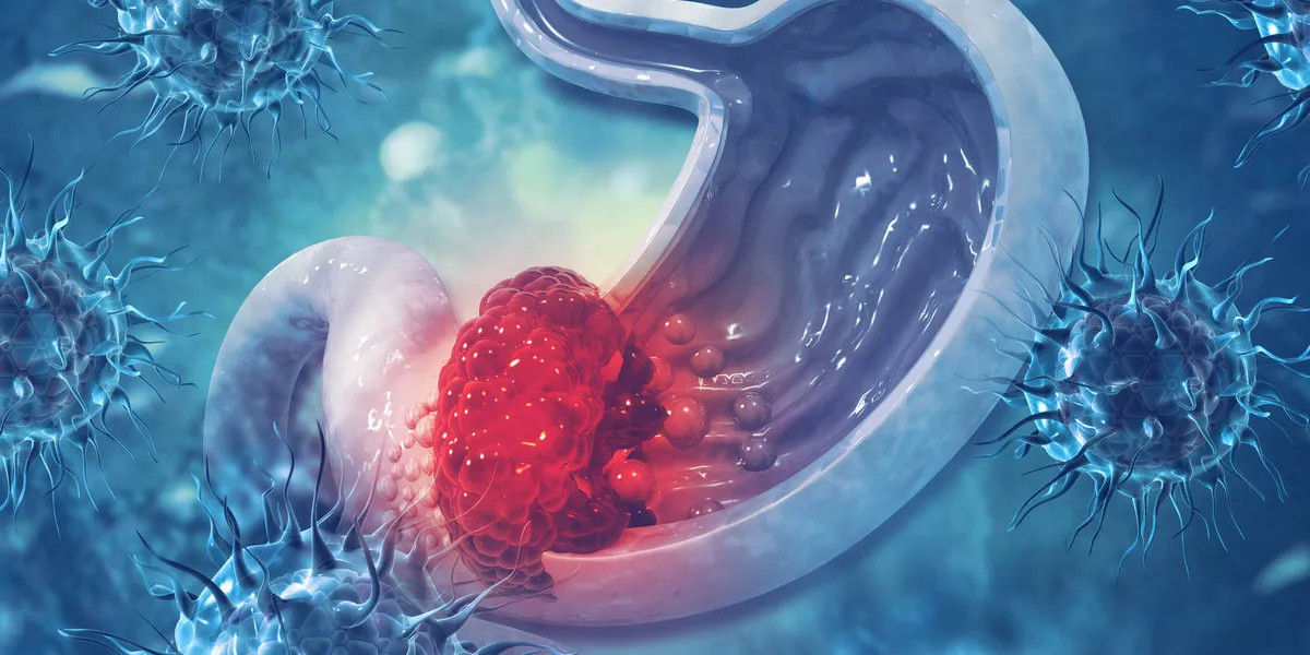 stomach cancer cancer attacking cell stomach disease concept 3d illustration stomach cancer cancer attacking cell stomach disease concept 3d illustration