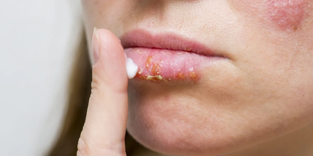 herpes