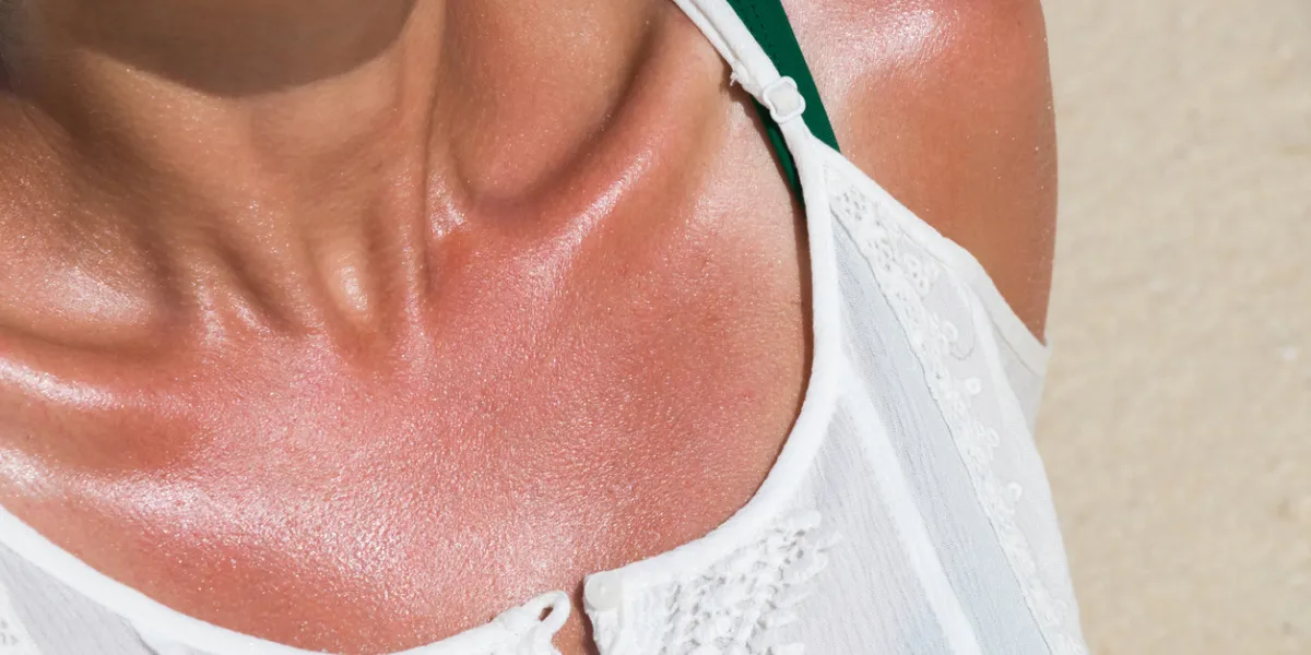 coup de soleil