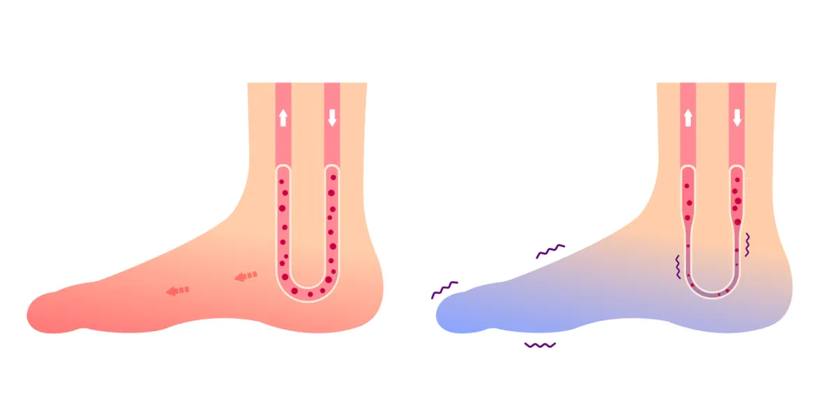 mains et pieds froid
