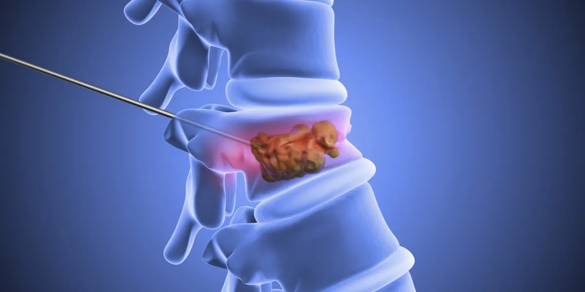 vertebropathie