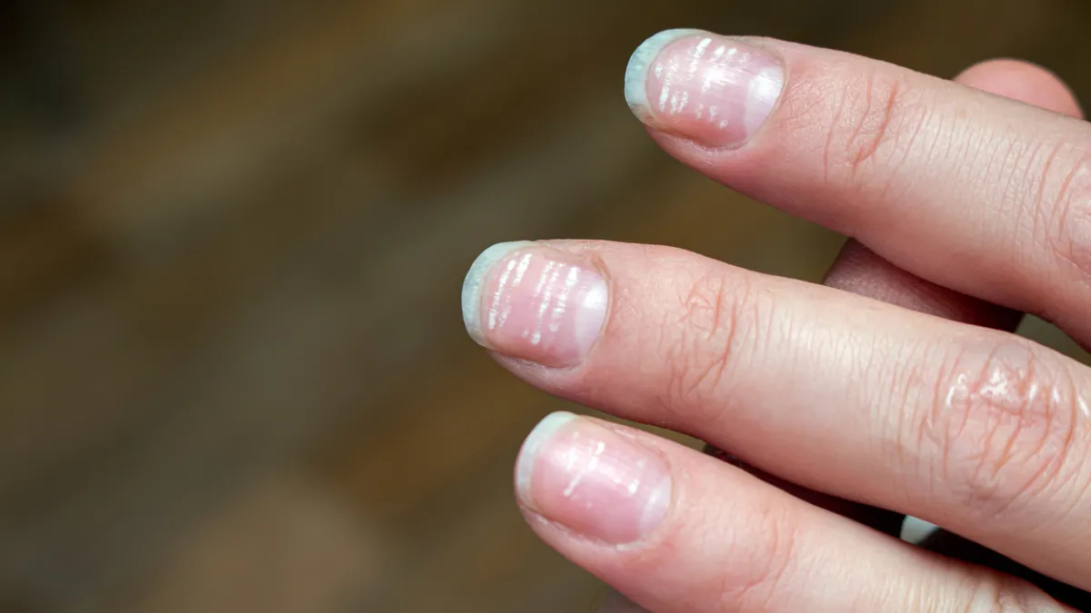 taches blanches ongles