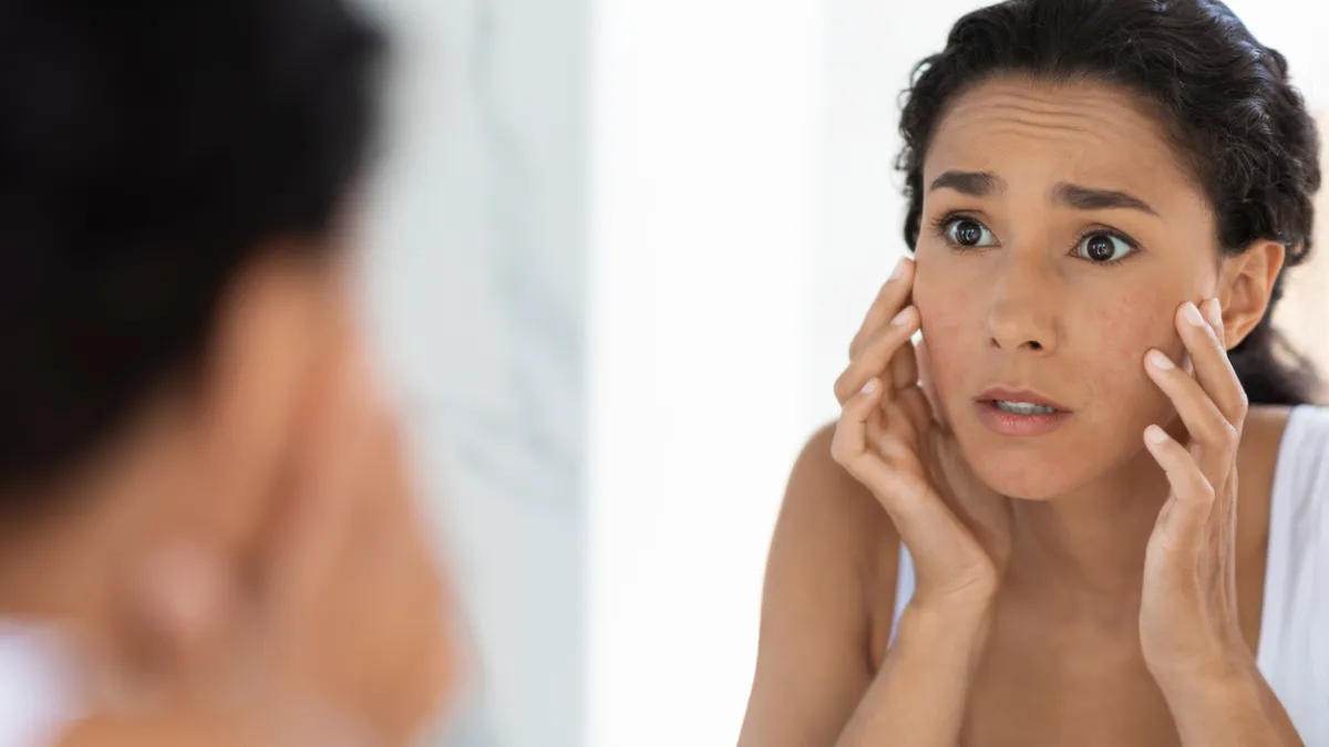 ECZEMA
