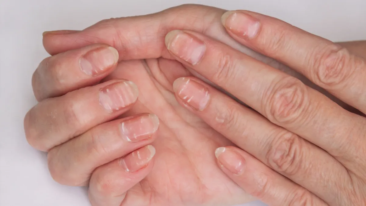 ongles cassant