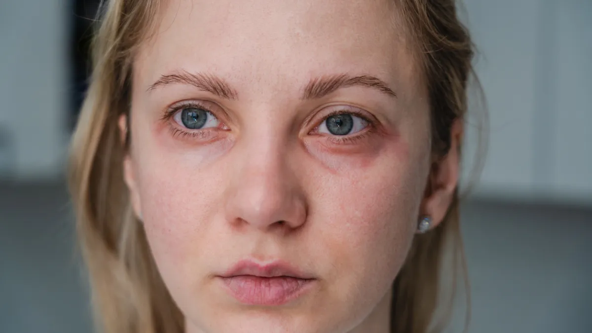 eczema