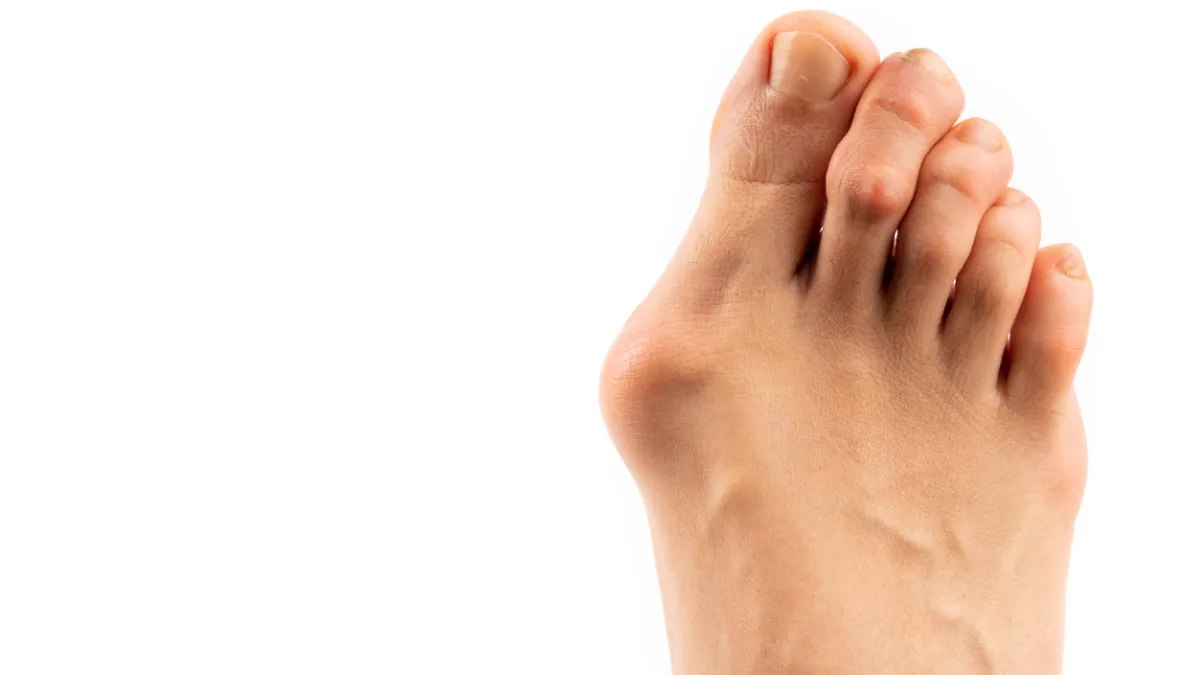 hallux valhus