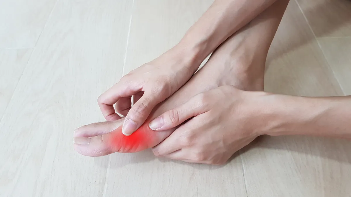 hallux valgus