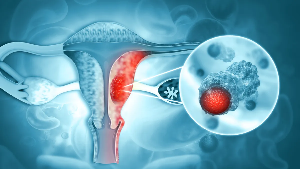 cancer ovaire