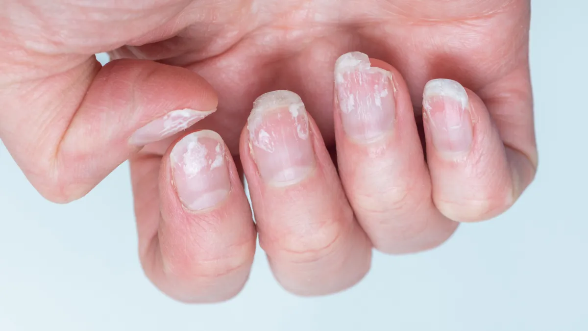ongle cassee