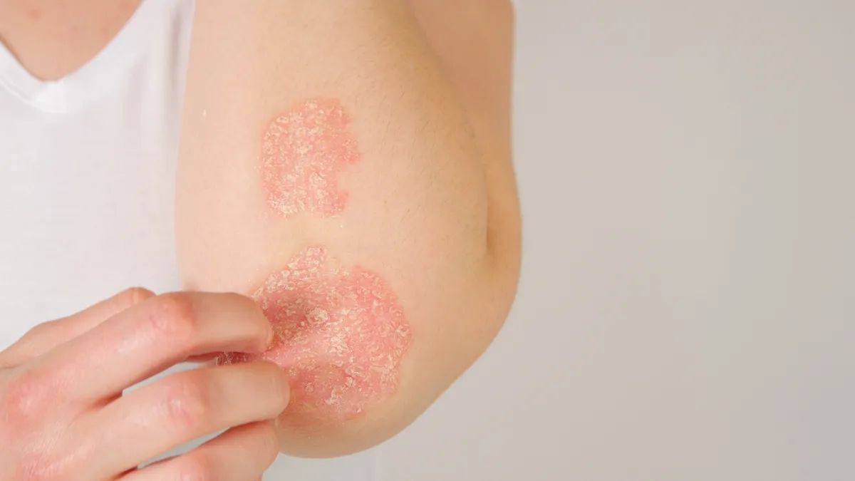 PSORIASIS