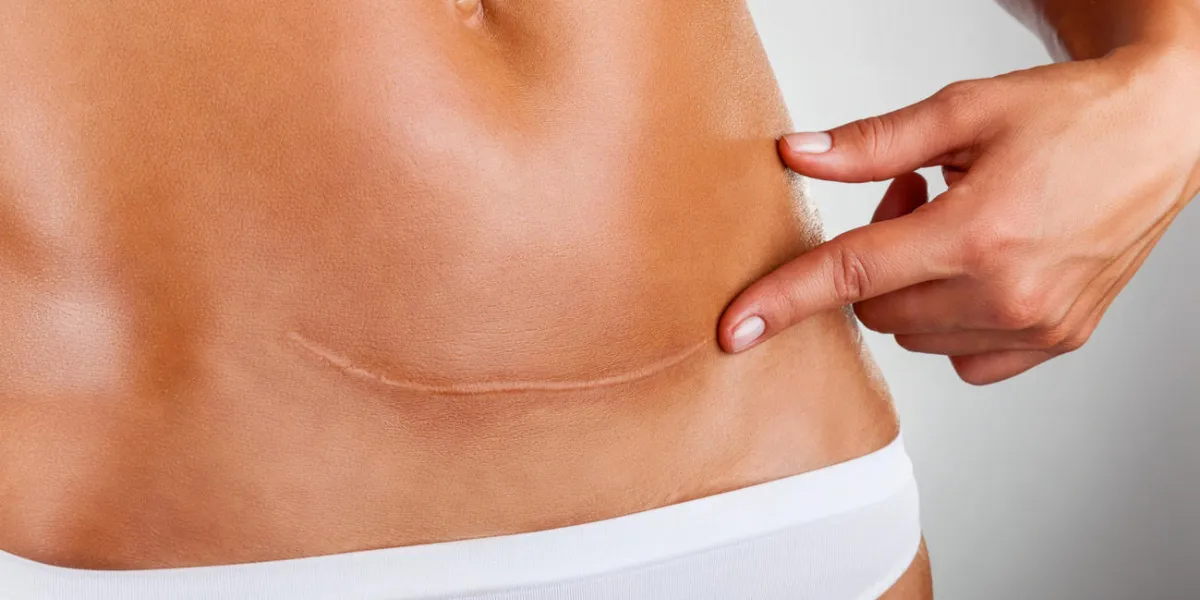 closeup of woman belly with a scar from a cesarean section