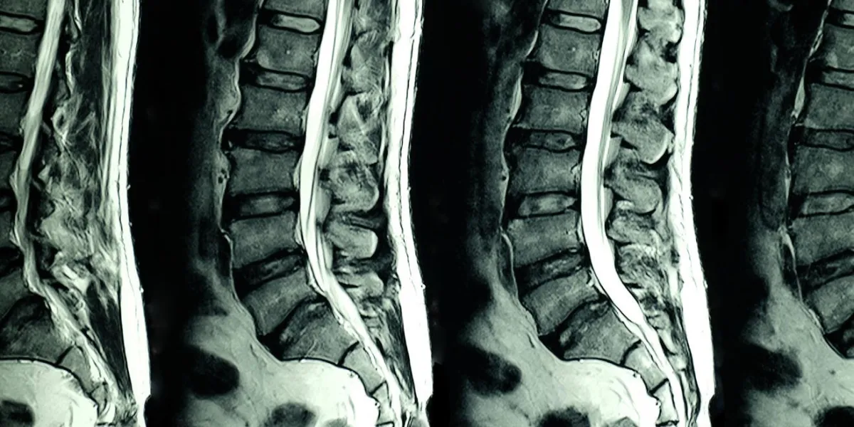 mri scan of lumbar spines of a patient with chronic back pain showing degenerative change of the l spines with right lateral protrution of l4-5 disc and l4 nerve root compression