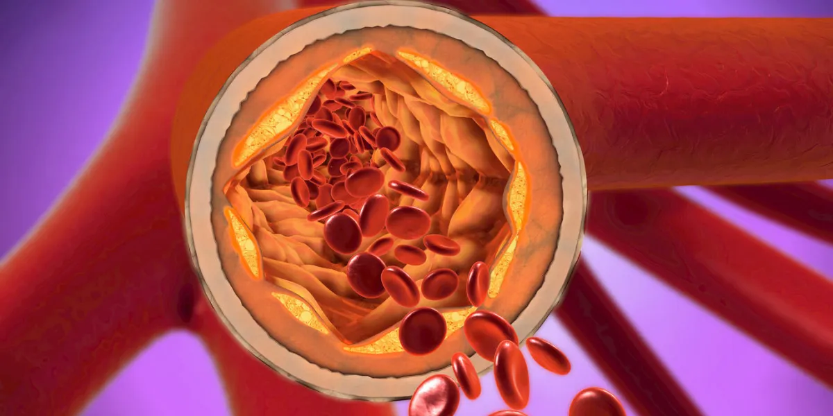 3d illustration of a precipitated and narrowing blood vessels or arteriosclerosis 3d illustration of a precipitated and narrowing blood vessels or arteriosclerosis