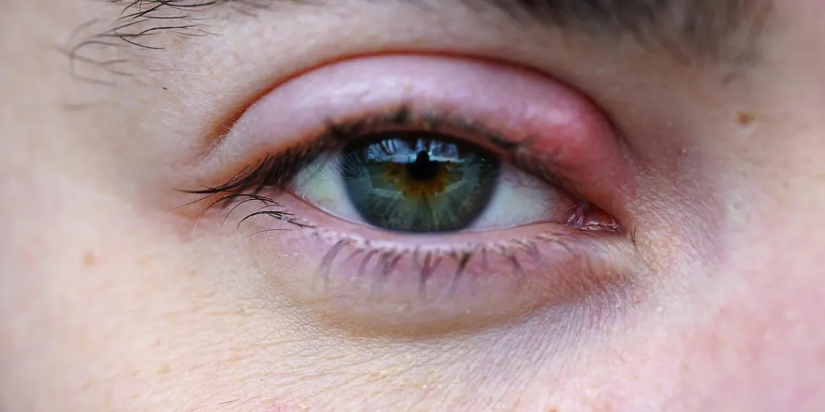 eye stye macro eye stye macro