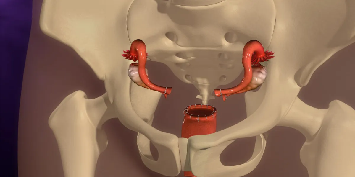 a hysterectomy is an operation to remove a woman's uterus a woman may have a hysterectomy for different reasons, including uterine fibroids that cause pain, bleeding, or other problems a hysterectomy is an operation to remove a woman's uterus a woman may have a hysterectomy for different reasons, including uterine fibroids that cause pain, bleeding, or other problems