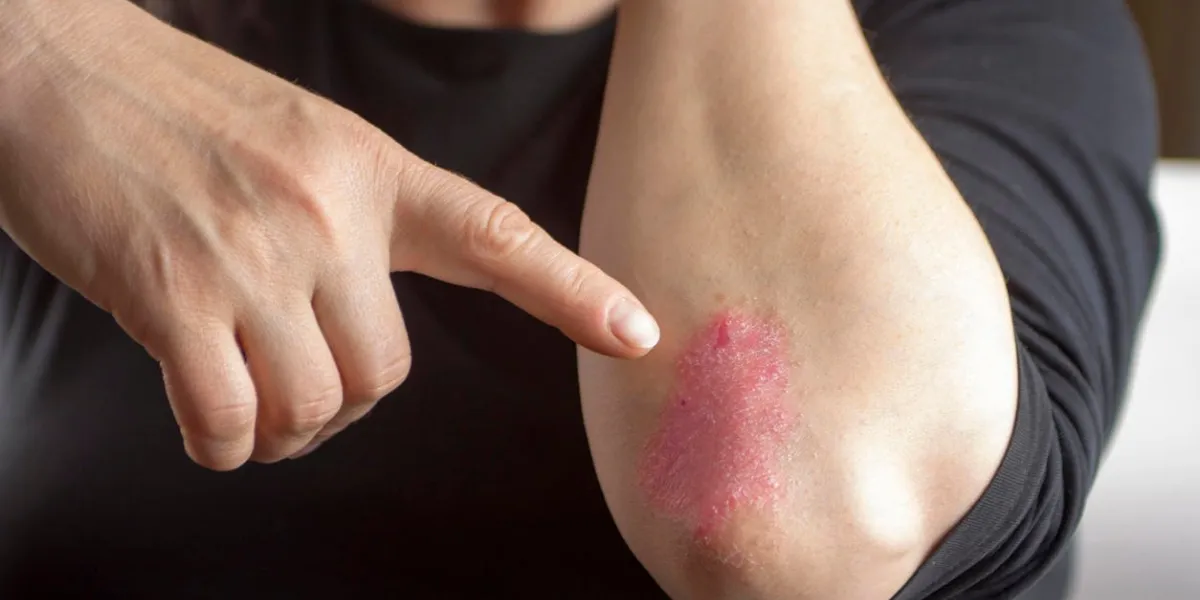 psoriasis sur le coude