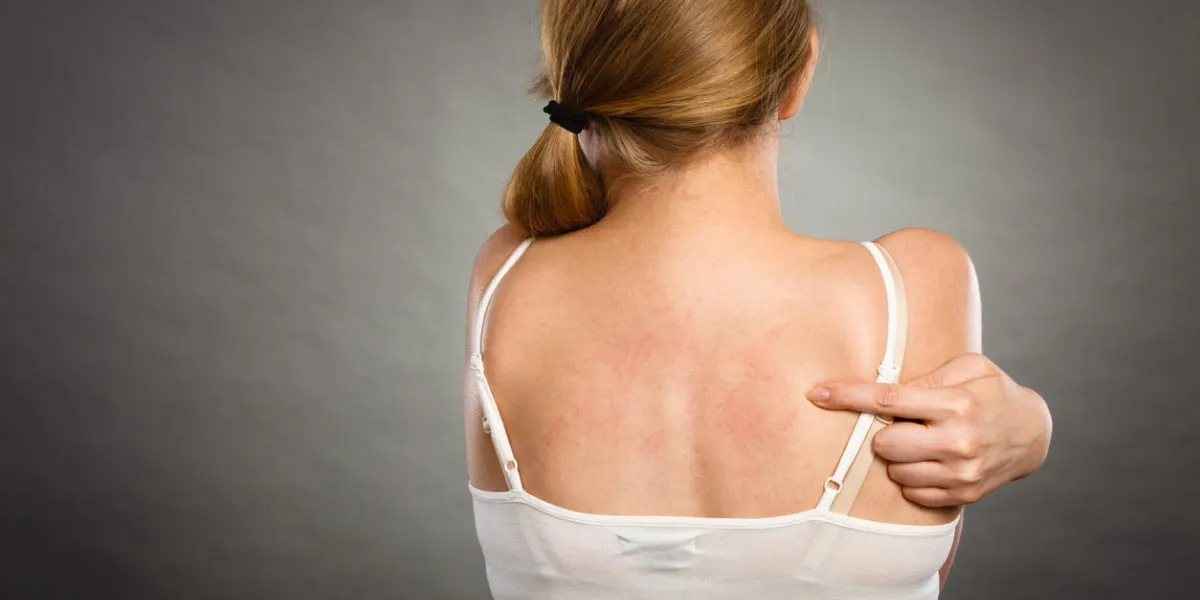 health problem, skin diseases young woman showing her itchy back with allergy rash urticaria symptoms health problem, skin diseases young woman showing her itchy back with allergy rash urticaria symptoms