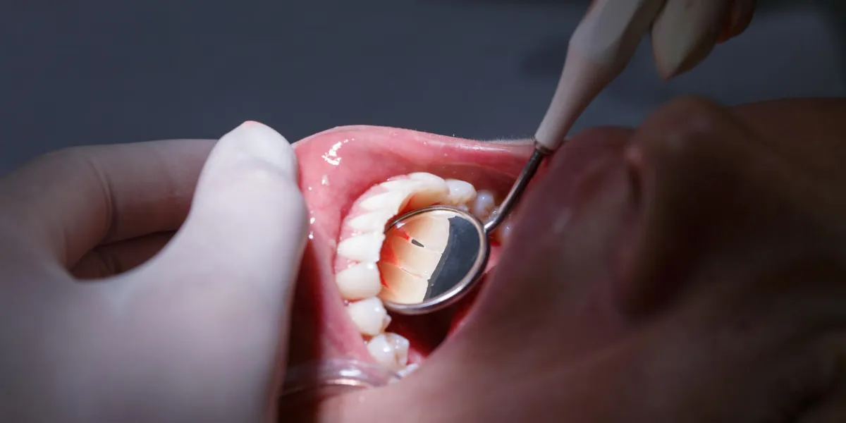 patient at dentists office, getting her white teeth interdental spaces examined with hand-held mirror for tartar and plaque dental hygiene, painful procedures and prevention concept patient at dentists office, getting her white teeth interdental spaces examined with hand-held mirror for tartar and plaque dental hygiene, painful procedures and prevention concept