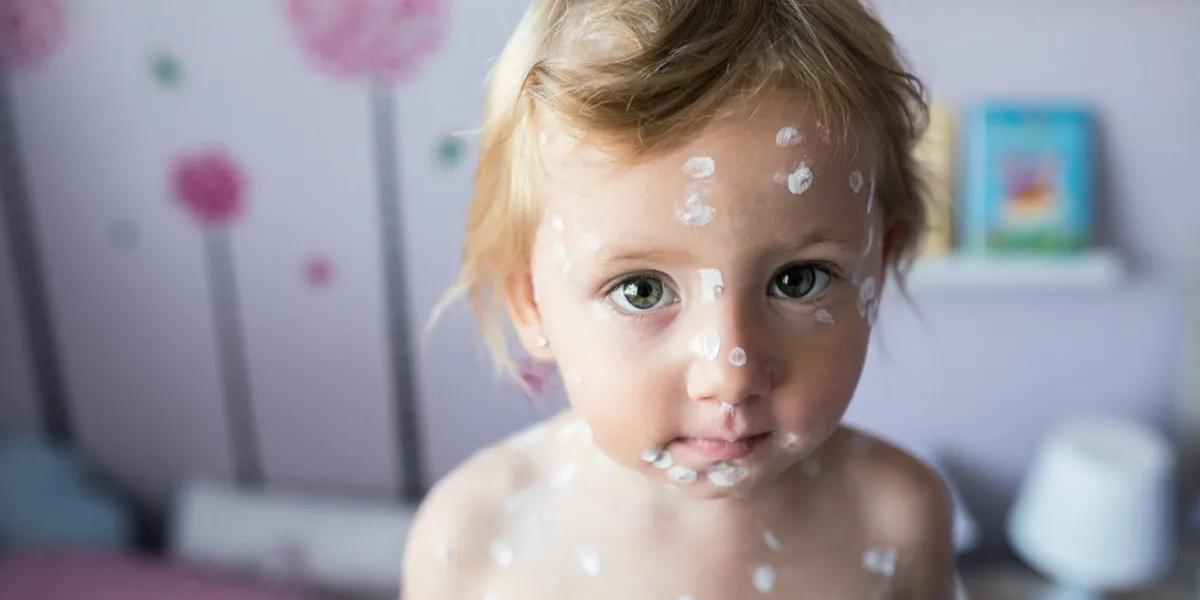 little two year old girl at home sick with chickenpox, white antiseptic cream applied to the rash