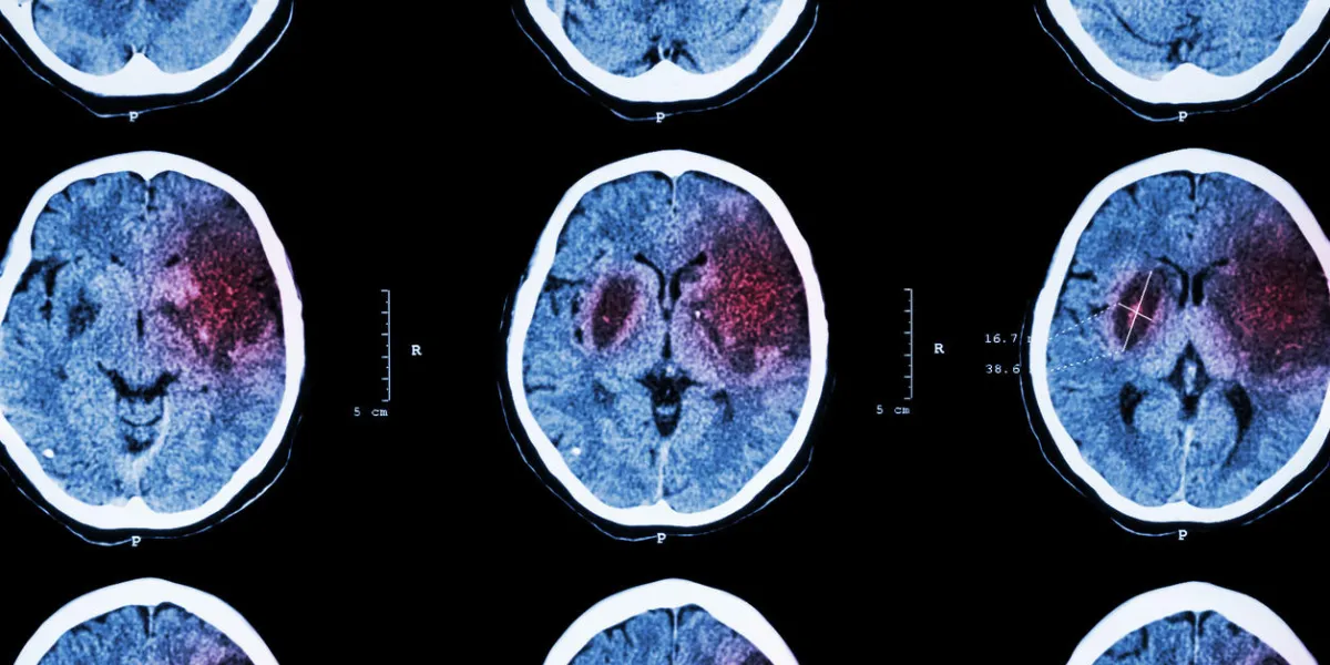 ischemic stroke ( ct of brain show cerebral infarction at left frontal - temporal - parietal lobe ) ( nervous system background ) ischemic stroke ( ct of brain show cerebral infarction at left frontal - temporal - parietal lobe ) ( nervous system background )