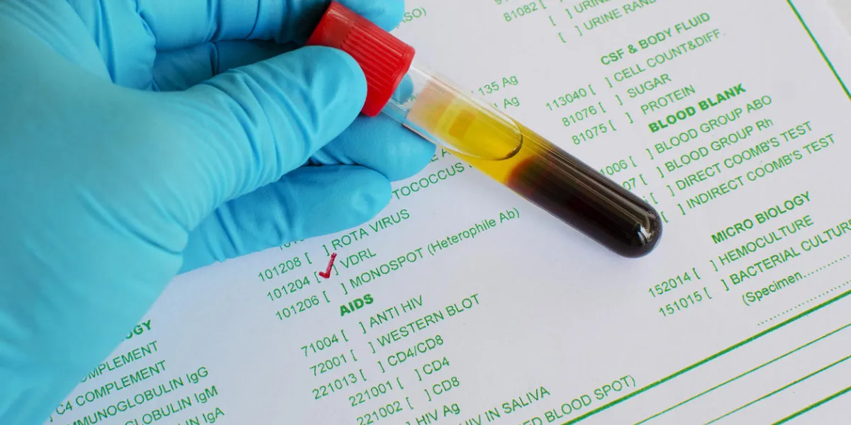 blood sample for vdrl testing blood sample for vdrl testing