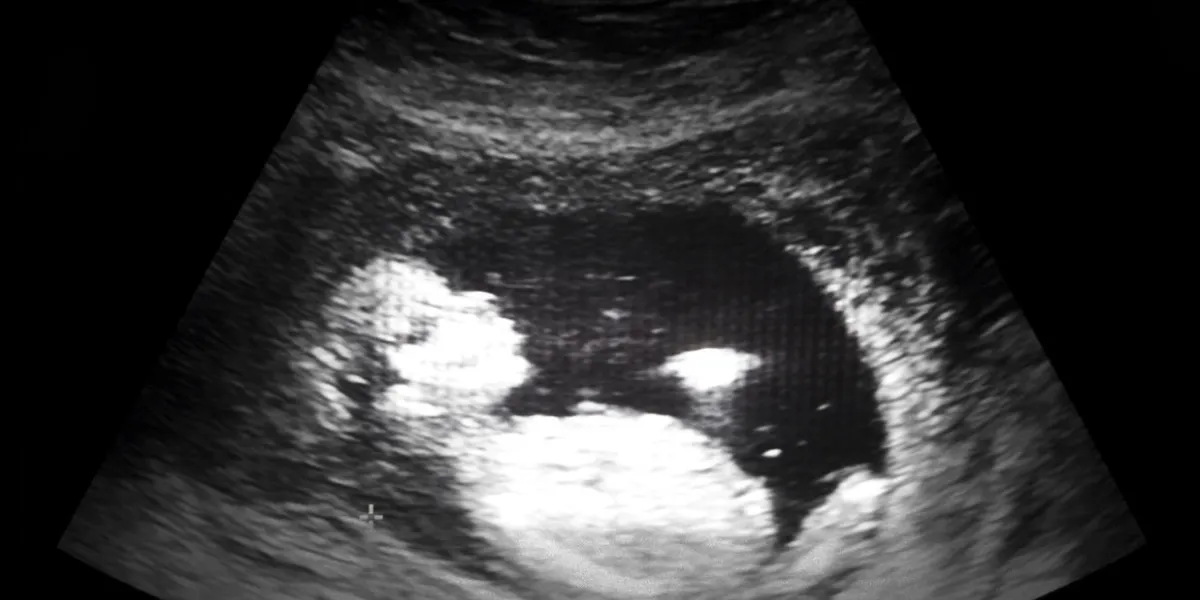 ultrasound film of thirteen week fetus