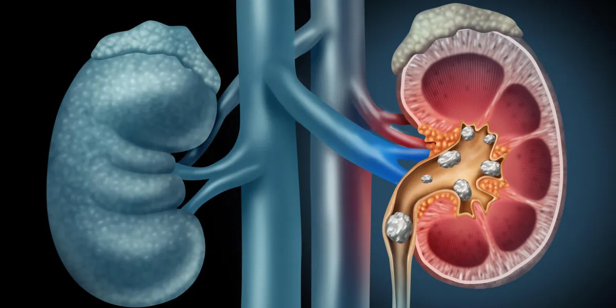 human kidney stones medical concept as an organ with painful crystaline mineral formations as a medicine symbol with a cross section with 3d illustration elements