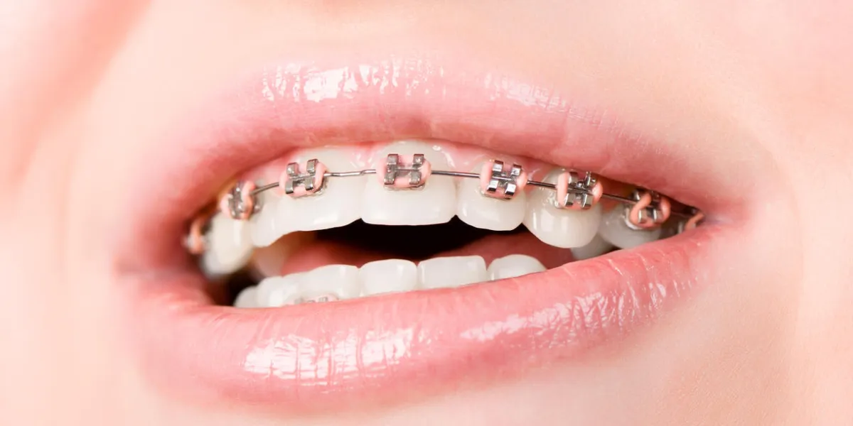 beautiful young woman with brackets on teeth close up beautiful young woman with brackets on teeth close up