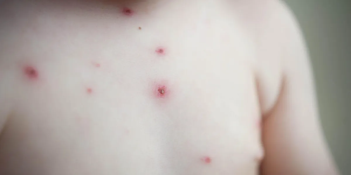 chickenpox - disease