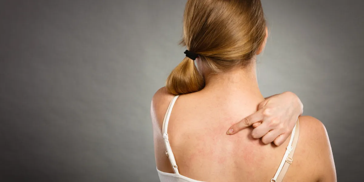 problème de santé, les maladies de la peau jeune femme montrant ses démangeaisons de retour avec des symptômes d'urticaire éruption allergique problème de santé, les maladies de la peau jeune femme montrant ses démangeaisons de retour avec des symptômes d'urticaire éruption allergique