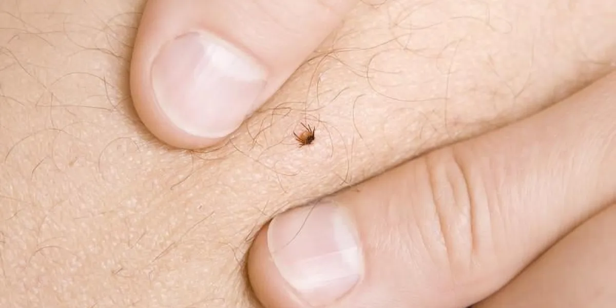 correct removing a tick from skin of patient