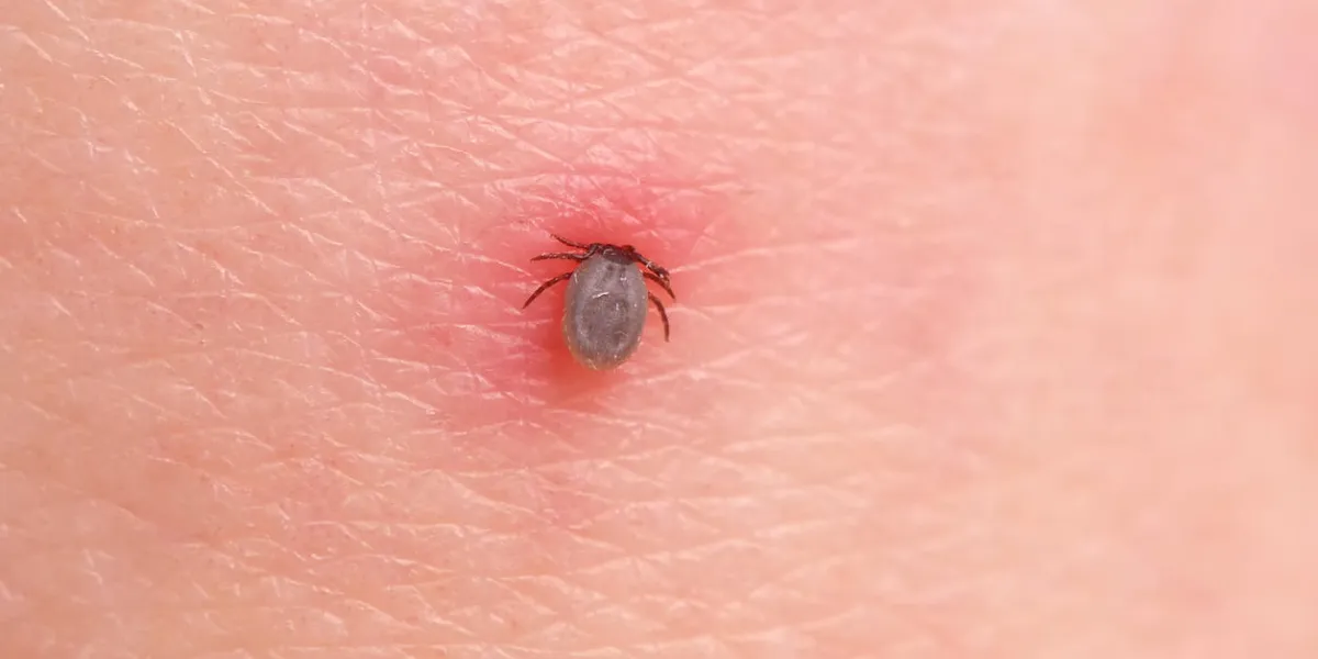 the tick bites the person, sucked deep under the skin the tick bites the person, sucked deep under the skin
