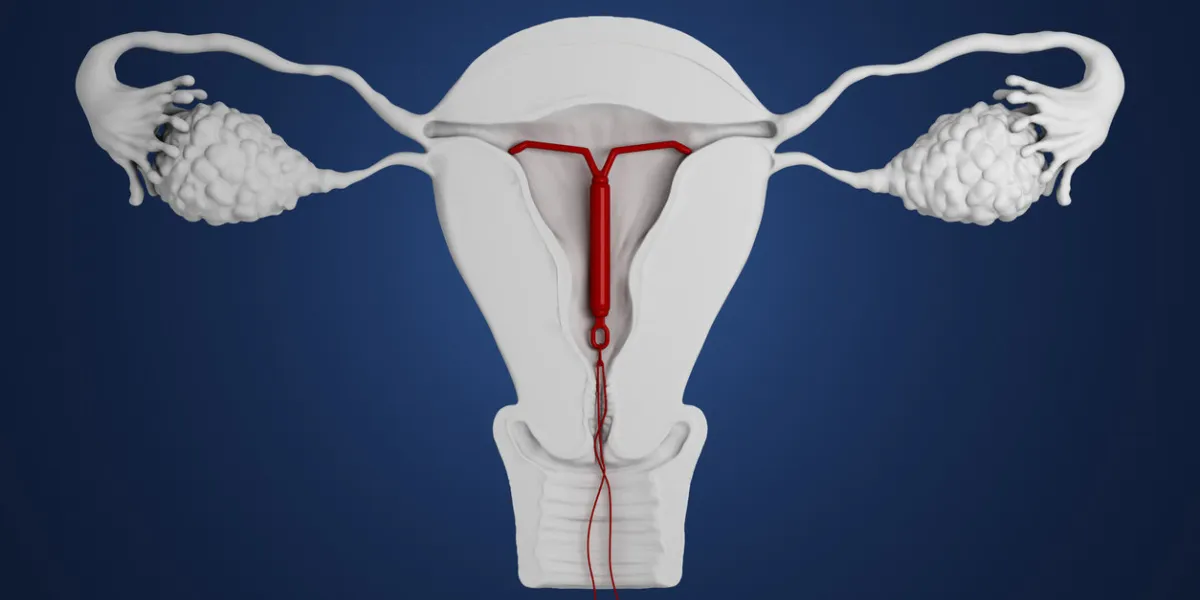 3d rendered illustration of an intra-uterine device